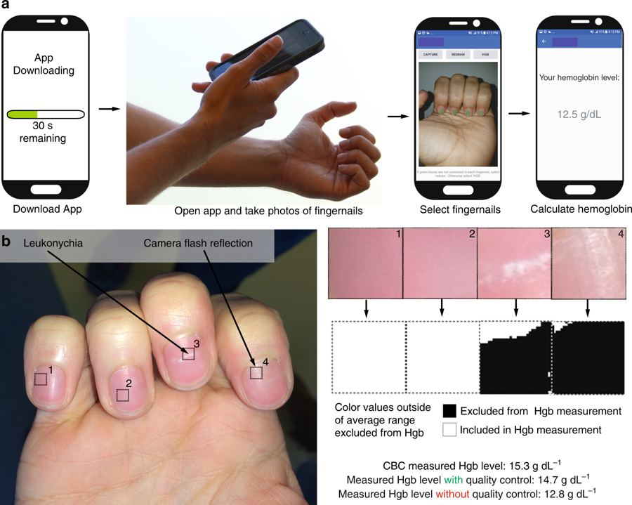 researchers-develop-cross-platform-app-to-test-for-anemia-with-a-single