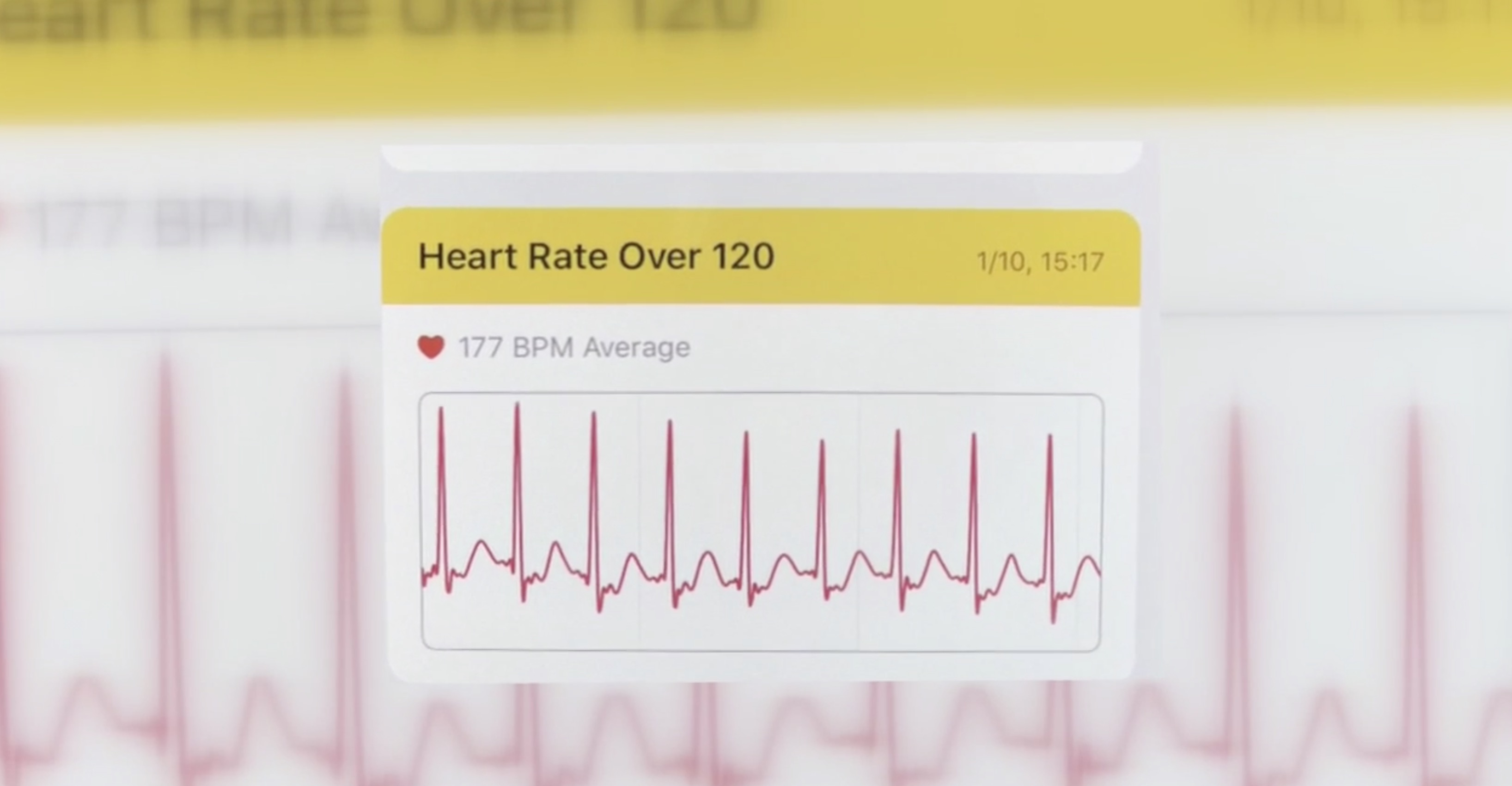 Apple Watch Helps Woman Discover Supraventricular Tachycardia Heart