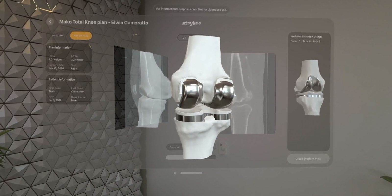 Vision Pro helps surgeons plan and visualize operations | Knee surgery visualization shown