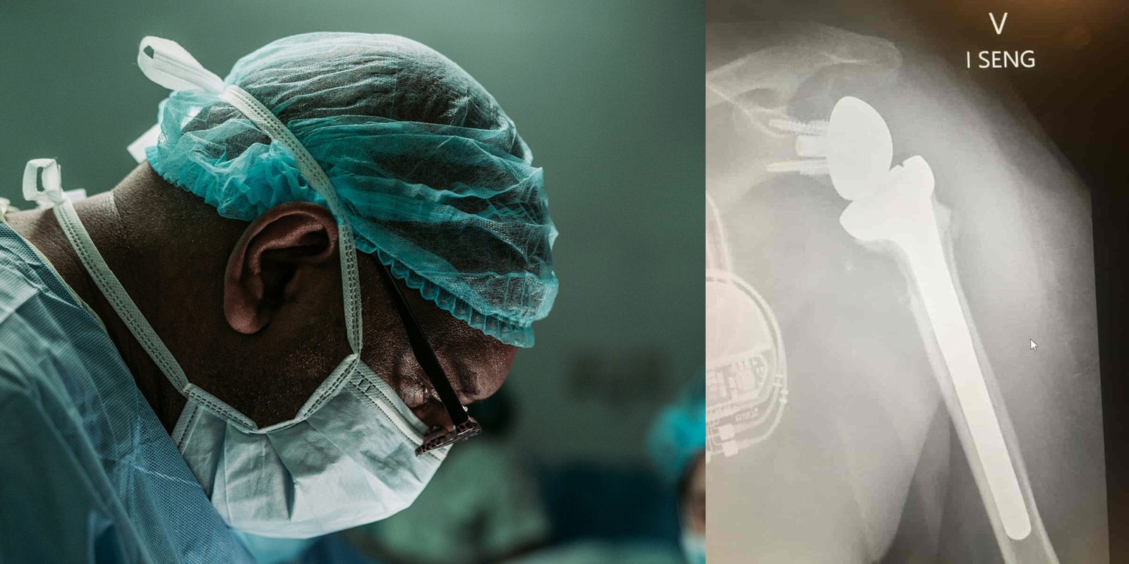 Vision Pro-chirurgie assistée |  Chirurgien et radiographie du remplacement inversé de l'épaule
