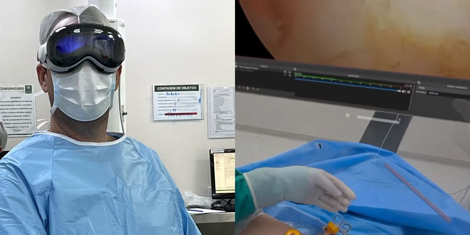 Apple Vision Pro utilisé pour assister un médecin lors d'une opération d'arthroscopie de l'épaule au Brésil